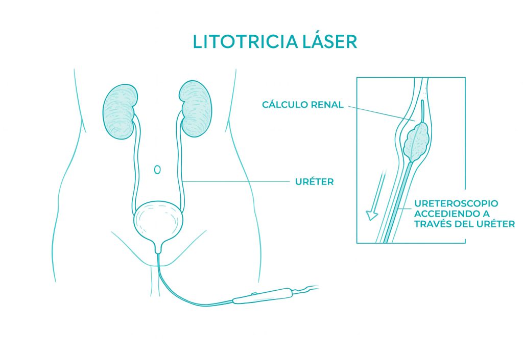 En la litotricia láser el ureteroscopio accede al uréter y extrae el cálculo capturándolo en una cesta Infografía que muestra el proceso de una litotricia láser